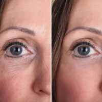 ST-Eye-Treatment-Before-After